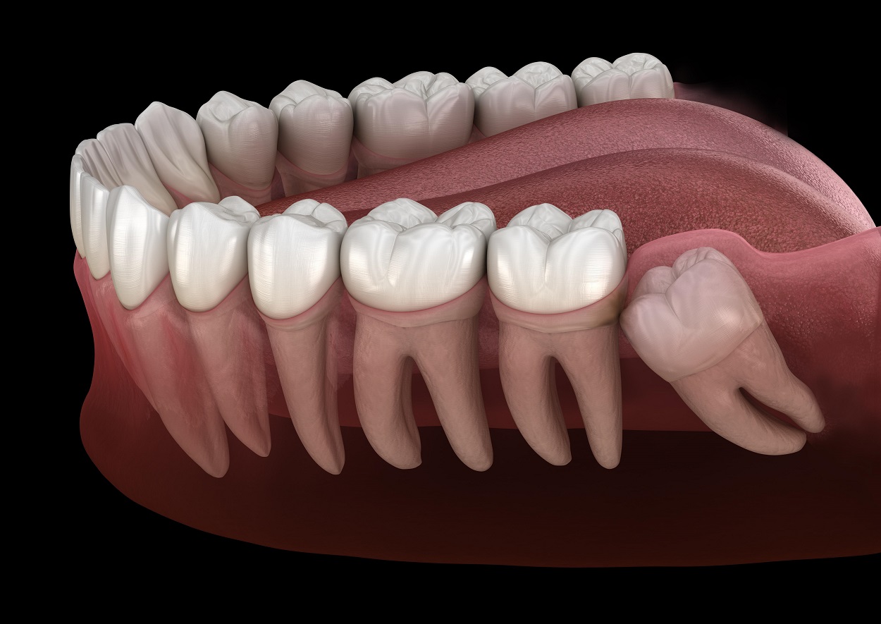 Симптомы сверхкомплектных зубов